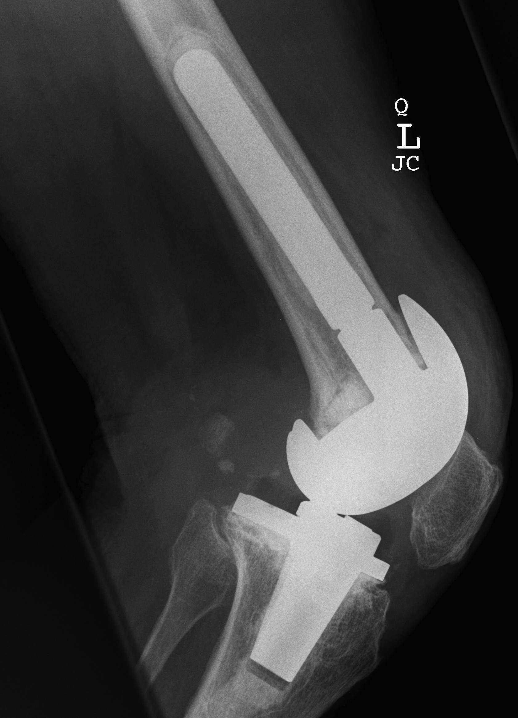 Revision TKR Loosening HInge Lateral